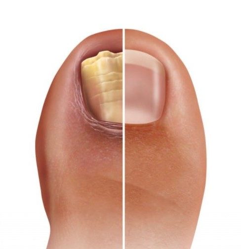 Shellac Lackierung